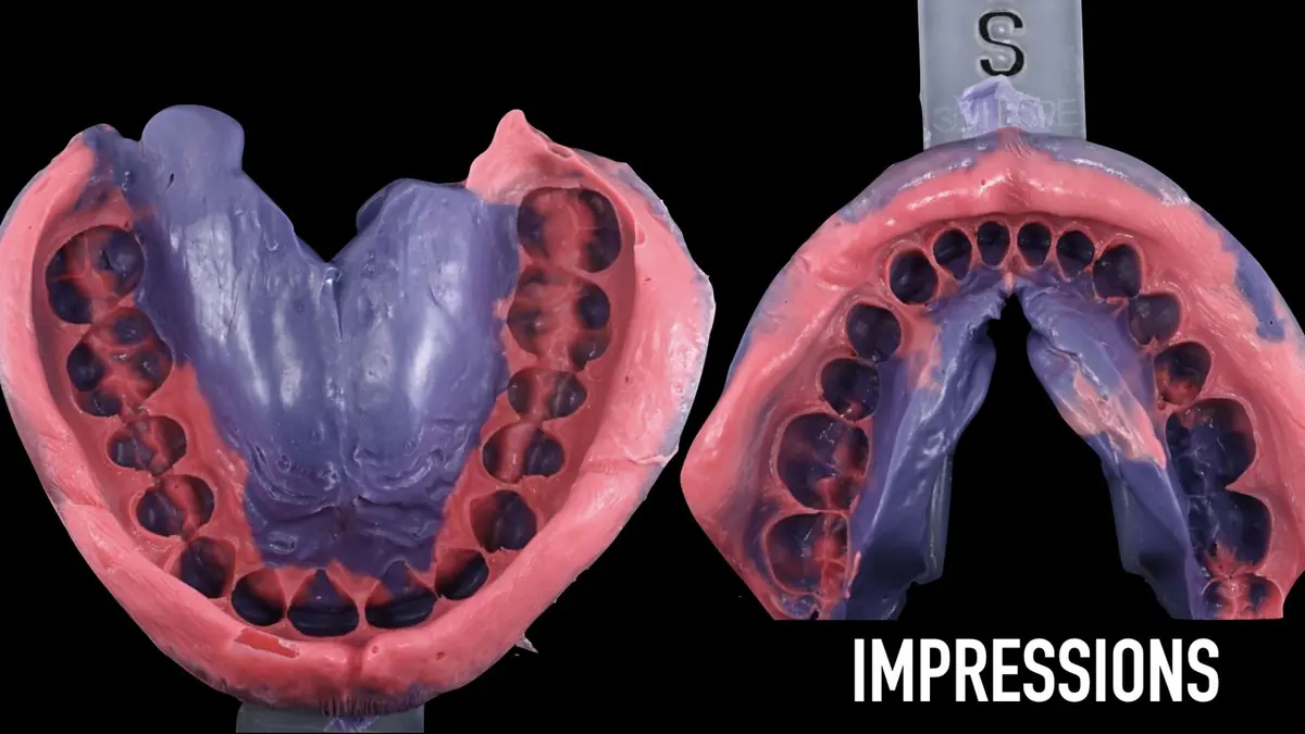 Upper and lower polyether impressions in their trays