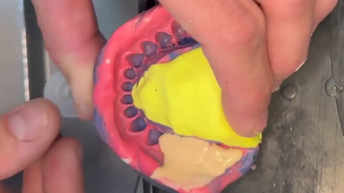 Type IV stone poured into a polyether impression